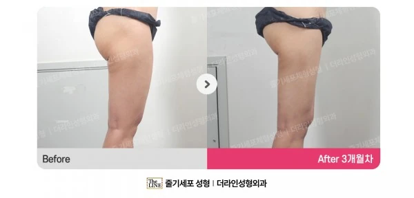 Thigh Liposuction before-and-after photo, before surgery - TheLINE Plastic Surgery