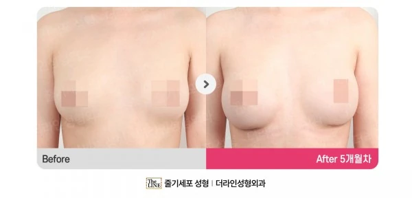 Breast Augmentation + Breast Fat Graftin before-and-after photo, before surgery - TheLINE Plastic Surgery