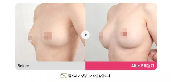 Breast Augmentation + Breast Fat Graftin before-and-after photo, before surgery - TheLINE Plastic Surgery