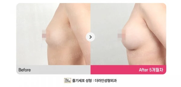 Breast Augmentation + Breast Fat Graftin before-and-after photo, before surgery - TheLINE Plastic Surgery