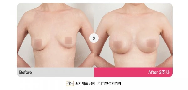 Breast Augmentation + Breast Fat Graftin before-and-after photo, before surgery - TheLINE Plastic Surgery