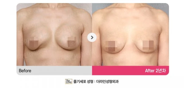 Breast Augmentation + Breast Fat Graftin before-and-after photo, before surgery - TheLINE Plastic Surgery