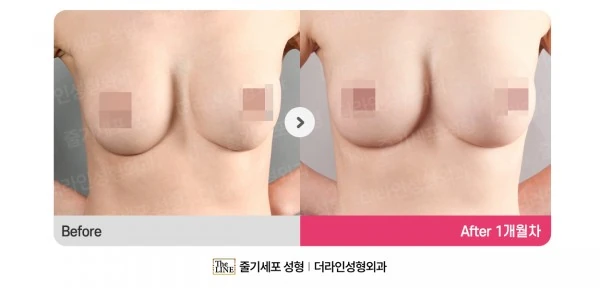Breast Augmentation + Breast Fat Graftin before-and-after photo, before surgery - TheLINE Plastic Surgery