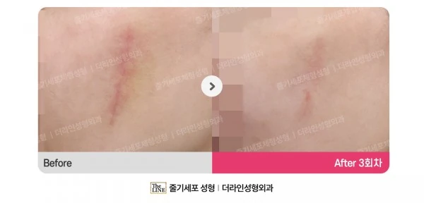 Stem Cell Scar Treatment before-and-after photo, before surgery - TheLINE Plastic Surgery