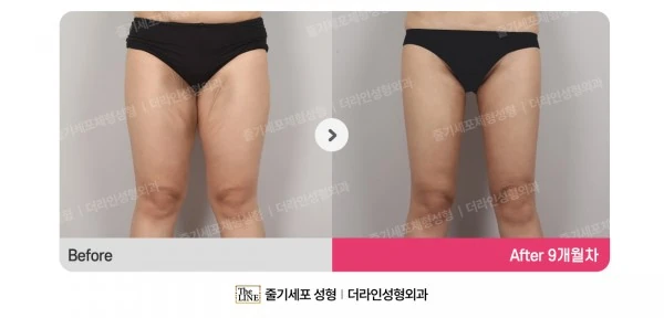 Thigh Lift before-and-after photo, before surgery - TheLINE Plastic Surgery