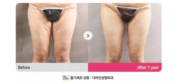 Thigh Lift before-and-after photo, before surgery - TheLINE Plastic Surgery
