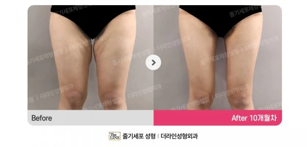 Thigh Lift before-and-after photo, before surgery - TheLINE Plastic Surgery