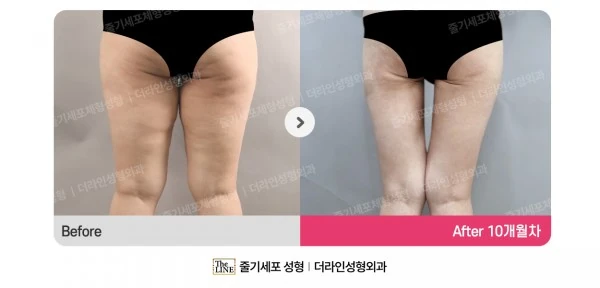 Thigh Lift before-and-after photo, before surgery - TheLINE Plastic Surgery