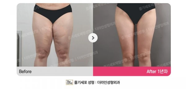 Thigh Lift before-and-after photo, before surgery - TheLINE Plastic Surgery
