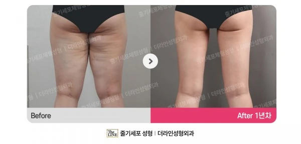 Thigh Lift before-and-after photo, before surgery - TheLINE Plastic Surgery