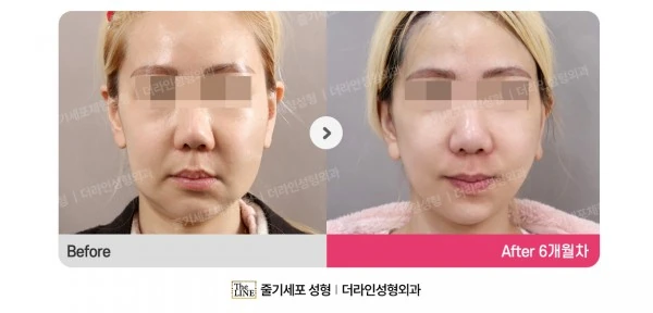 Deep Plane Facelift before-and-after photo, before surgery - TheLINE Plastic Surgery