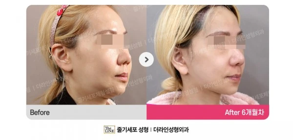 Deep Plane Facelift before-and-after photo, before surgery - TheLINE Plastic Surgery