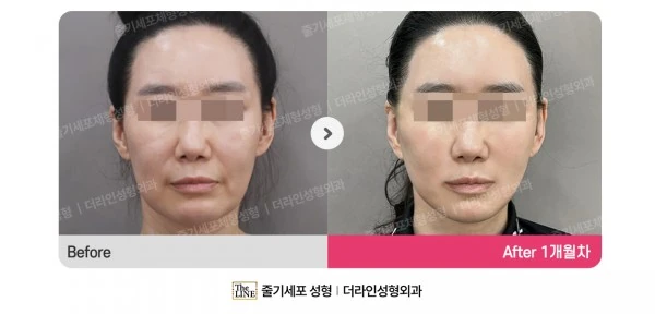 Deep Plane Facelift before-and-after photo, before surgery - TheLINE Plastic Surgery
