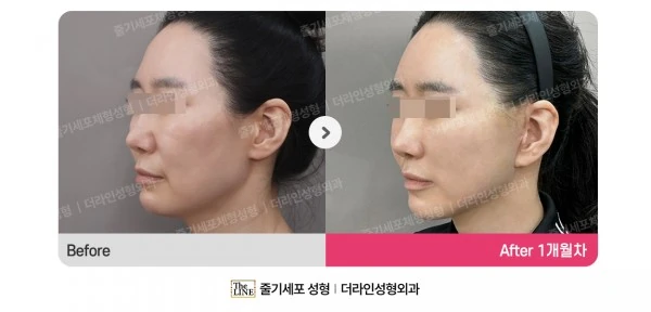 Deep Plane Facelift before-and-after photo, before surgery - TheLINE Plastic Surgery