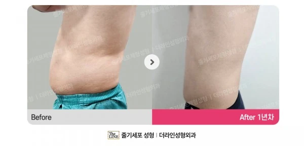 Male Abdominal Liposuction before-and-after photo, before surgery - TheLINE Plastic Surgery