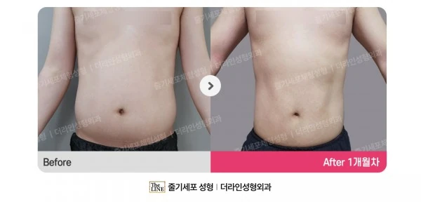 Male Abdominal Liposuction before-and-after photo, before surgery - TheLINE Plastic Surgery