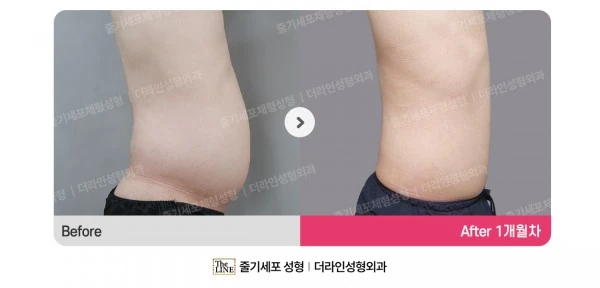 Male Abdominal Liposuction before-and-after photo, before surgery - TheLINE Plastic Surgery