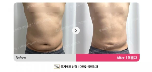 Male Abdomen and Love Handle Liposuction, before and after 1 month at Seoul Lipo Center