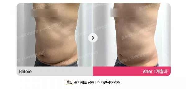 Male Abdomen and Love Handle Liposuction before-and-after photo, before surgery - TheLINE Plastic Surgery