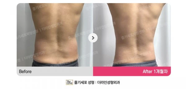 Male Abdomen and Love Handle Liposuction before-and-after photo, before surgery - TheLINE Plastic Surgery