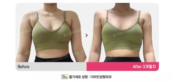 Arm Liposuction before-and-after photo, before surgery - TheLINE Plastic Surgery