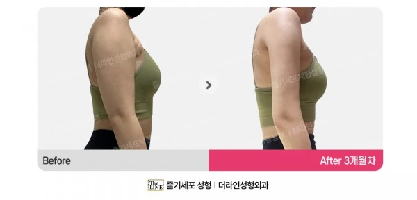 Arm Liposuction before-and-after photo, before surgery - TheLINE Plastic Surgery