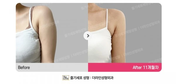 Arm Liposuction before-and-after photo, before surgery - TheLINE Plastic Surgery