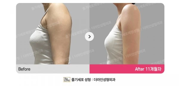 Arm Liposuction before-and-after photo, before surgery - TheLINE Plastic Surgery