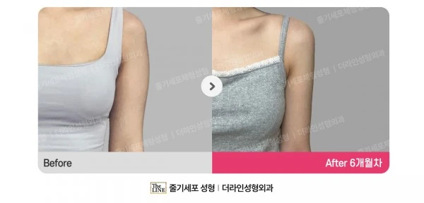 Arm Liposuction before-and-after photo, before surgery - TheLINE Plastic Surgery