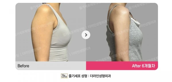 Arm Liposuction before-and-after photo, before surgery - TheLINE Plastic Surgery