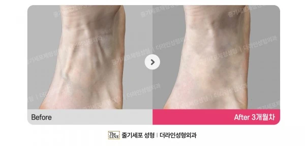 Hand & Foot Fat Grafting before-and-after photo, before surgery - TheLINE Plastic Surgery