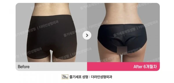 Hip Fat Grafting before-and-after photo, before surgery - TheLINE Plastic Surgery