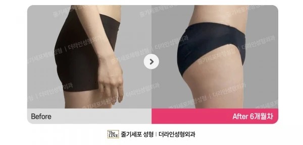 Hip Fat Grafting before-and-after photo, before surgery - TheLINE Plastic Surgery