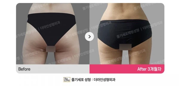 Hip Fat Grafting before-and-after photo, before surgery - TheLINE Plastic Surgery