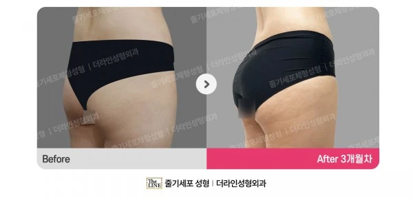 Hip Fat Grafting before-and-after photo, before surgery - TheLINE Plastic Surgery