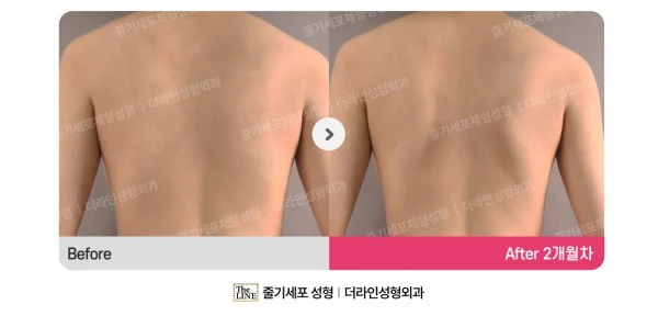 Special Area Liposuction, before and after 2 months at Seoul Lipo Center