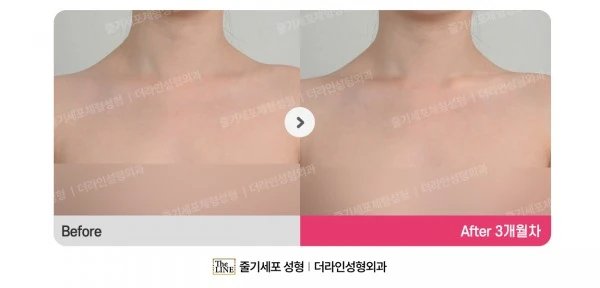 Special Area Liposuction, before and after 3 months at Seoul Lipo Center