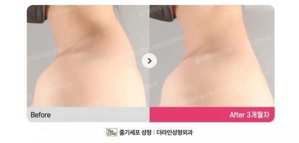 Special Area Liposuction, before and after 3 months at Seoul Lipo Center