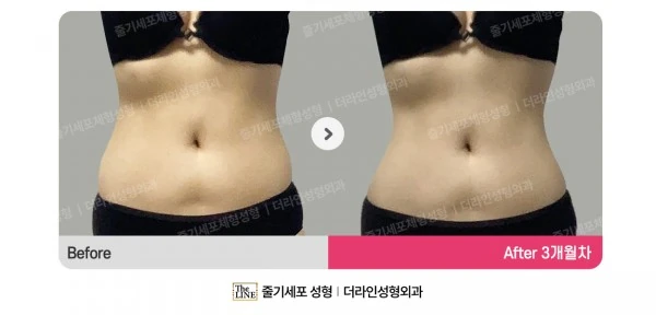 Ssak Injection before-and-after photo, before surgery - TheLINE Plastic Surgery