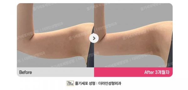 Ssak Injection before-and-after photo, before surgery - TheLINE Plastic Surgery