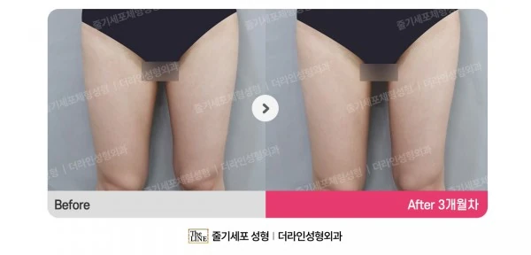 Ssak Injection before-and-after photo, before surgery - TheLINE Plastic Surgery