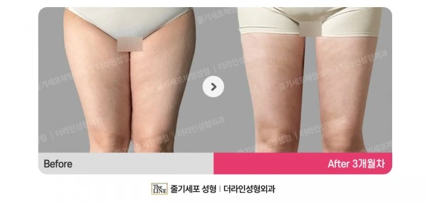 Liposuction Revision, before and after 3 months at Seoul Lipo Center