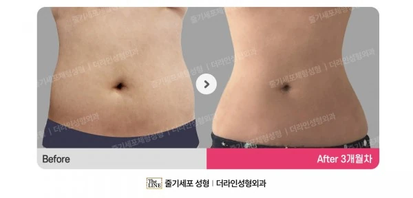 Liposuction Revision, before and after 3 months at Seoul Lipo Center
