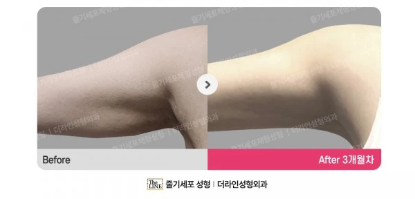 Liposuction Revision, before and after 3 months at Seoul Lipo Center
