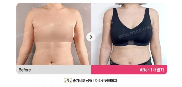 SlimSlim Suction (Bbaera-Bbaera) before-and-after photo, before surgery - TheLINE Plastic Surgery