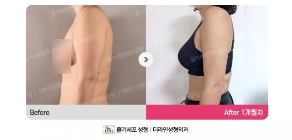SlimSlim Suction (Bbaera-Bbaera) before-and-after photo, before surgery - TheLINE Plastic Surgery