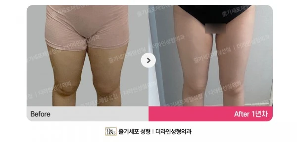 SlimSlim Suction (Bbaera-Bbaera) before-and-after photo, before surgery - TheLINE Plastic Surgery