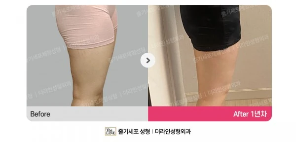 SlimSlim Suction (Bbaera-Bbaera) before-and-after photo, before surgery - TheLINE Plastic Surgery
