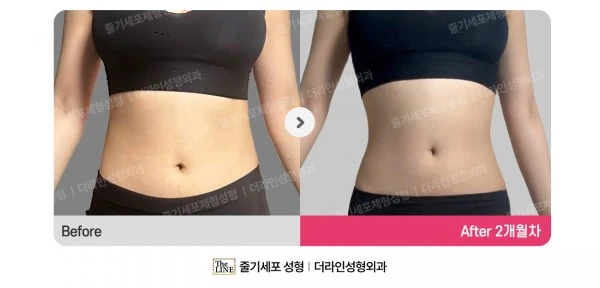 SlimSlim Suction (Bbaera-Bbaera) before-and-after photo, before surgery - TheLINE Plastic Surgery