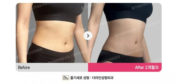 SlimSlim Suction (Bbaera-Bbaera) before-and-after photo, before surgery - TheLINE Plastic Surgery